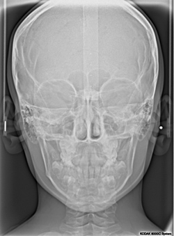 Röntgenaufnahme (frontal)